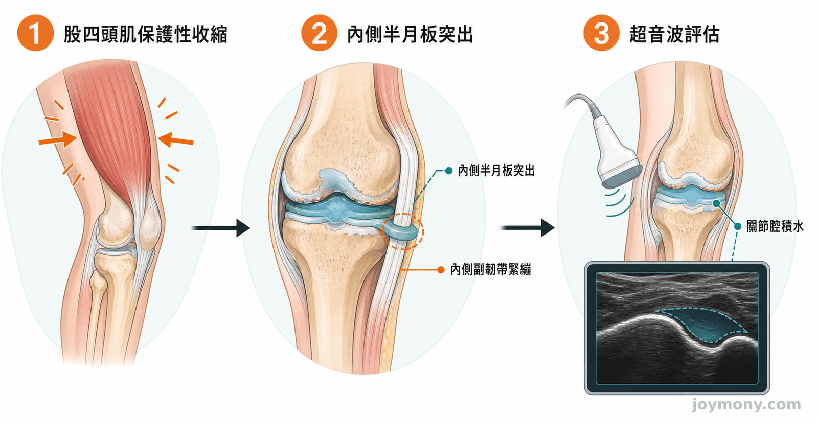 退化性膝關節炎示意：股四頭肌保護性攣縮標於大腿正前方，關節積水標於膝關節腔內