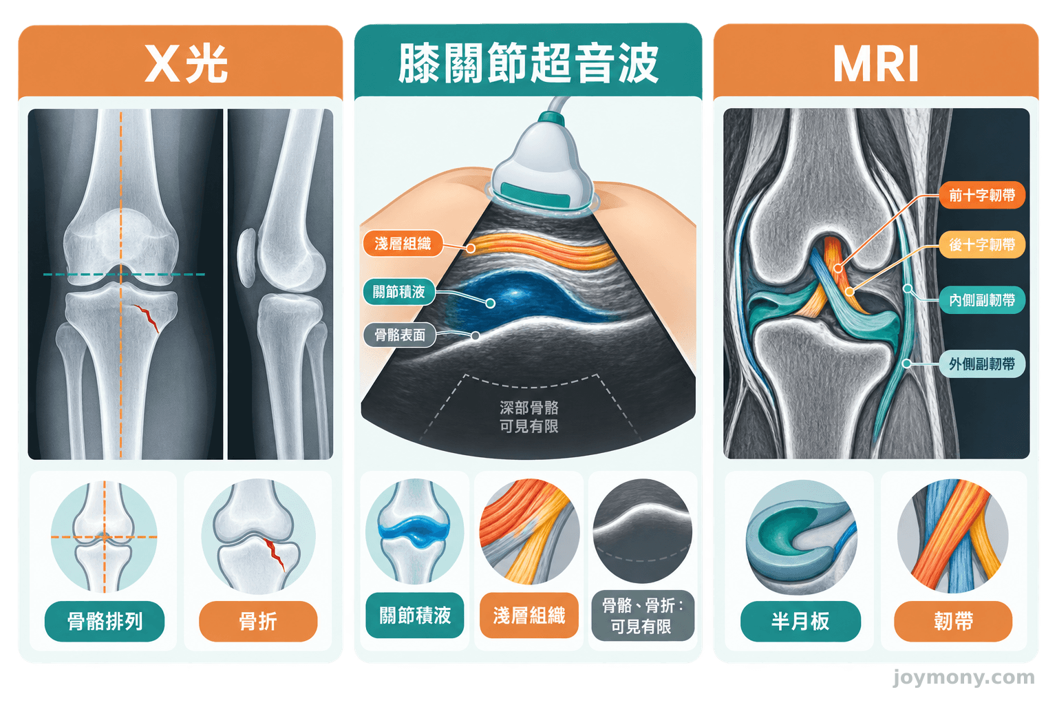 X光、膝關節超音波與MRI的可見範圍比較，超音波對骨骼與骨折為可見但有限