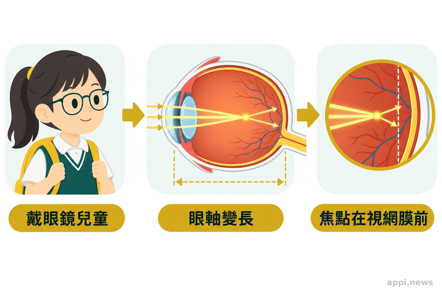 兒童戴眼鏡與近視眼球光線聚焦位置示意圖